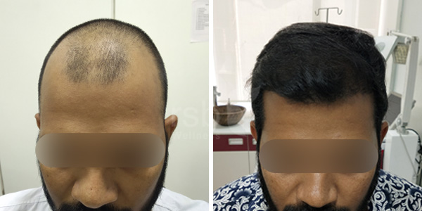 hair-transplant-treatement-mumbai-thane